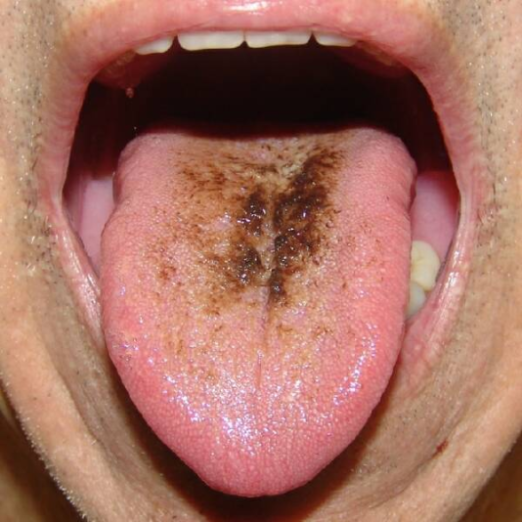 Black hairy tongue