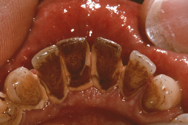 smoking tartar buildup