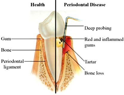 Periodontal Disease