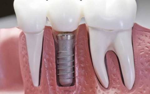 dental implants