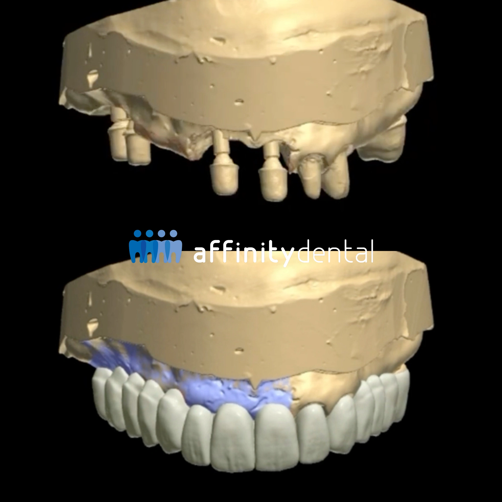 3D digital model in 3Shape showing implant abutments and zirconia fixed bridge design for guided implant surgery