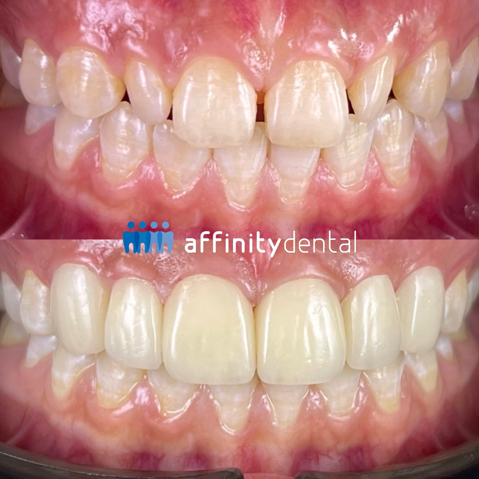 Before and after photo of 6-unit Emax porcelain veneers on upper front teeth, Affinity Dental Clinics Makati