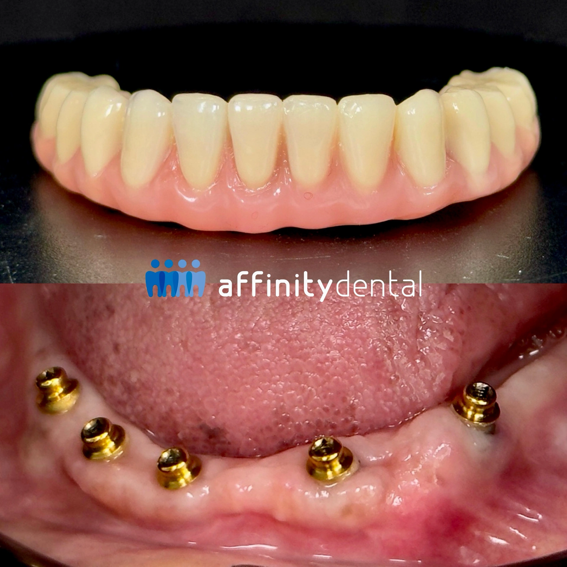 Close-up of a lower full arch All-on-X dental implant restoration with gold abutments and a fixed bridge at Affinity Dental Clinics Makati.