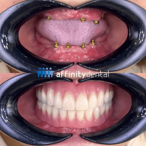 Before-and-after photos of a patient with All-on-X dental implants showing lower arch implant posts and final full arch prosthesis at Affinity Dental Clinics