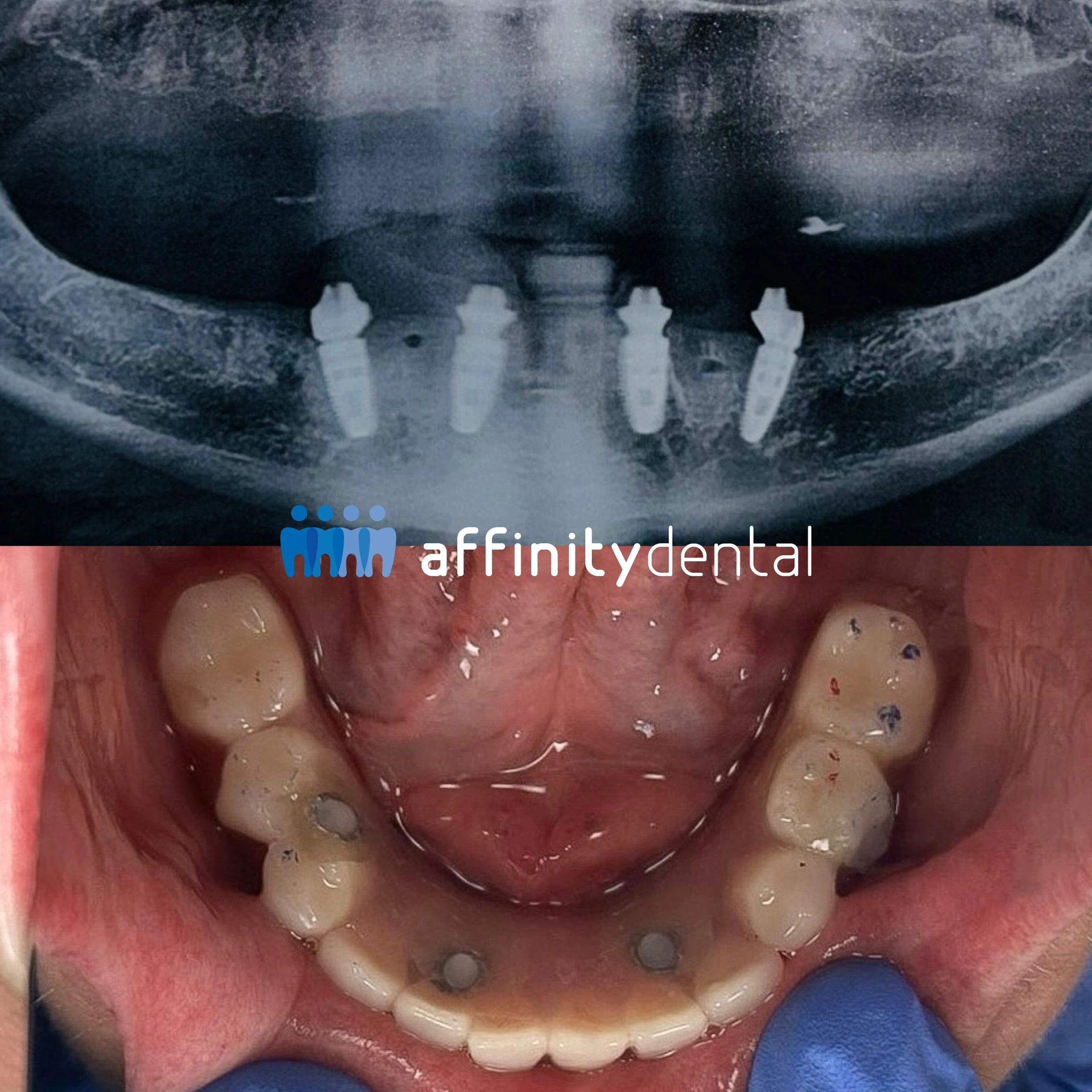 Panoramic X-ray and intraoral view of All-on-X dental implants placed in the lower jaw of an Australian patient at Affinity Dental Clinics Makati.