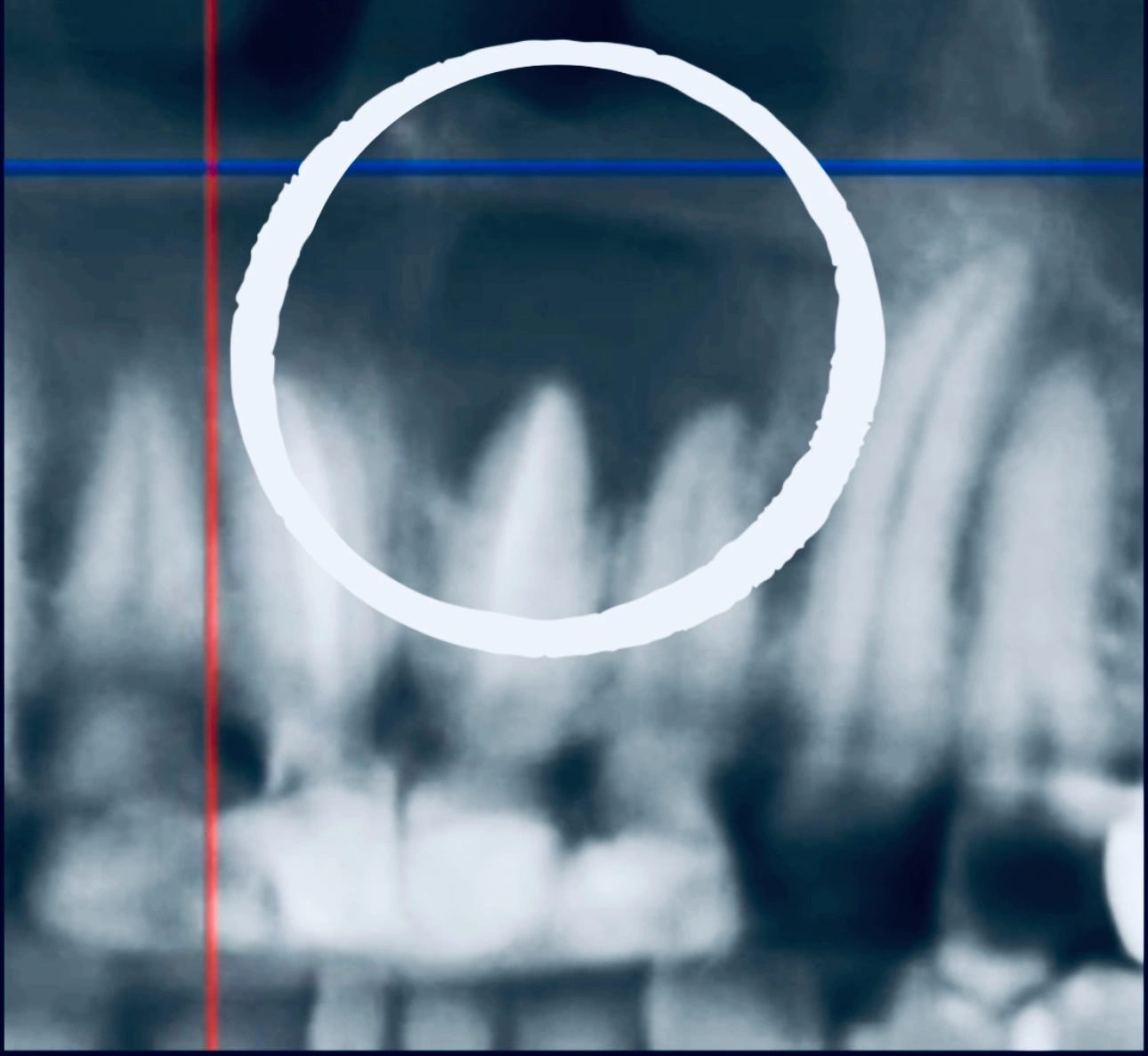 CBCT dental scan highlighting a periapical mass above the upper front tooth, scheduled for apicoectomy at Affinity Dental Clinics Makati.