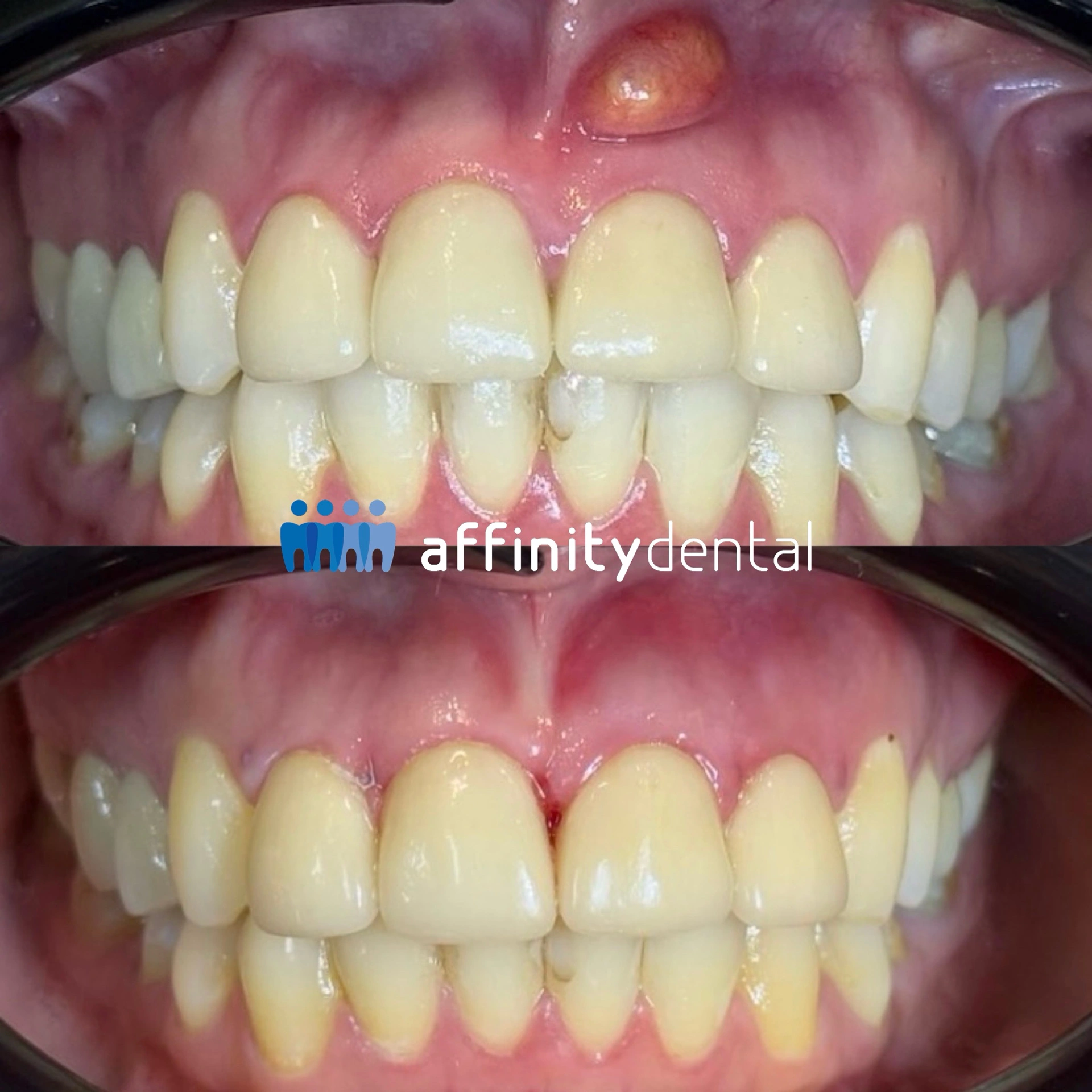 Before and after photos of a patient’s upper front teeth showing successful apicoectomy treatment of a sinus tract at Affinity Dental Clinics Makati.