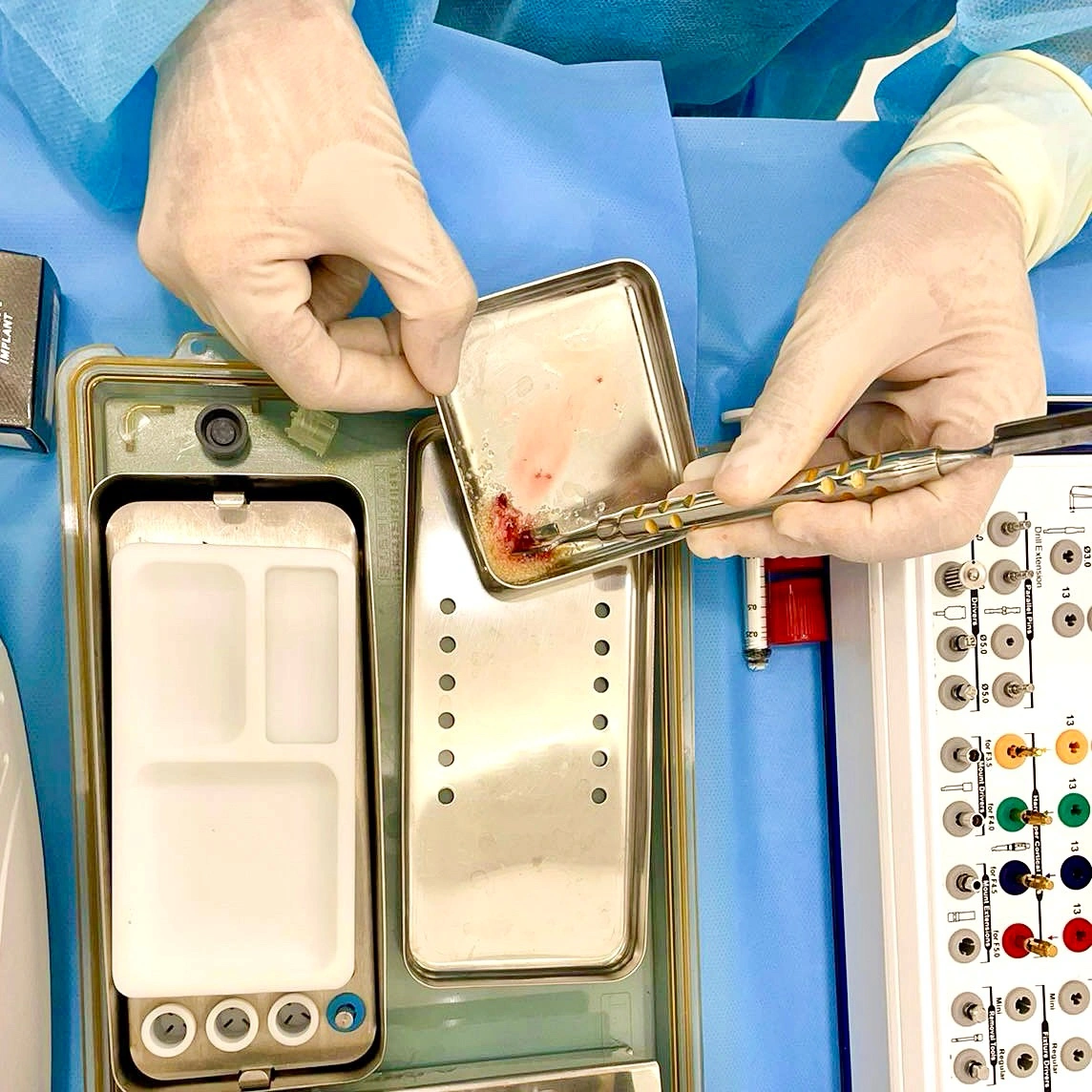 A dentist in surgical gloves handling bone graft material with dental instruments in a sterile stainless steel tray during a procedure at Affinity Dental Clinics.