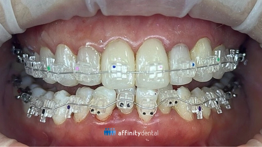 Close-up of teeth with ceramic braces showing clear brackets for a more aesthetic orthodontic option at Affinity Dental Clinics.