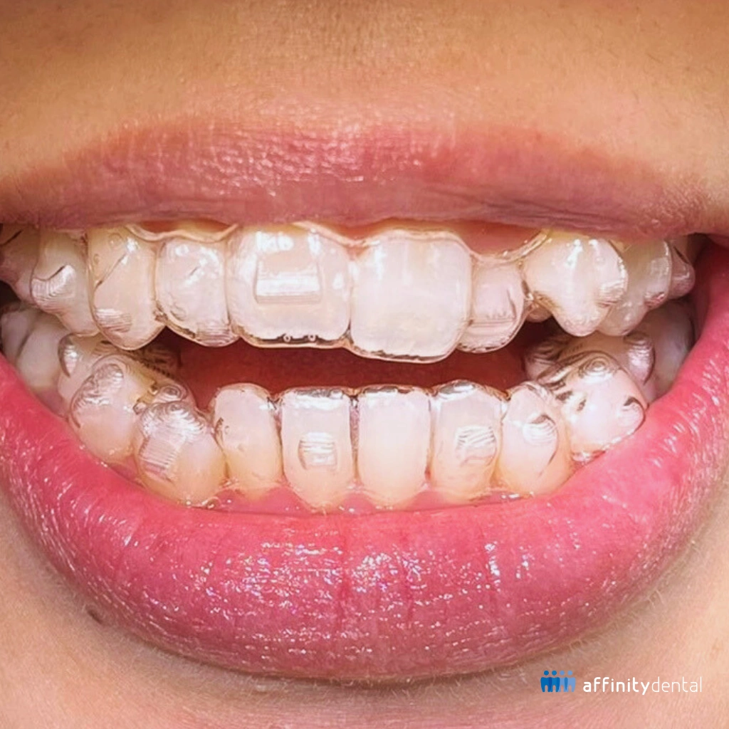Close-up of patient wearing Invisalign clear aligners at Affinity Dental Clinics