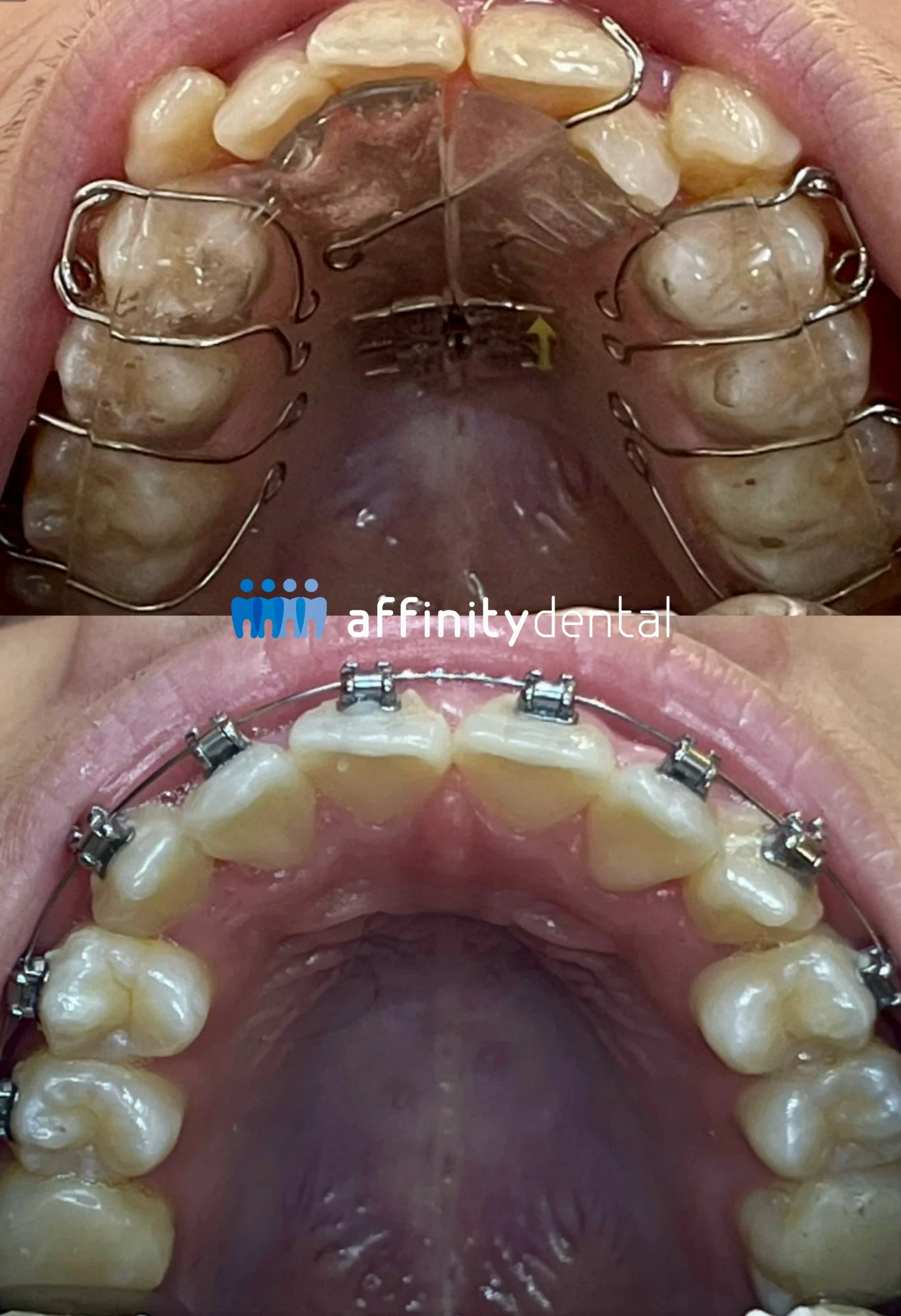 Upper jaw showing orthodontic treatment progression from palatal expander to braces at Affinity Dental Clinics BGC High Street