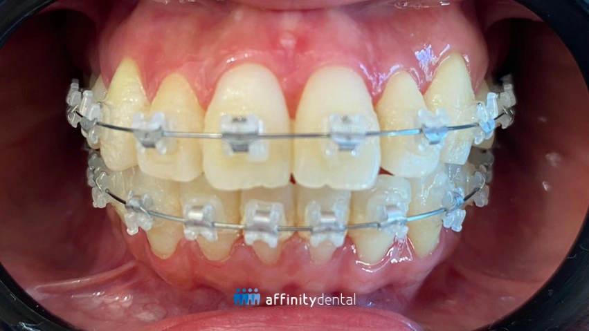 Close-up of teeth with self-ligating ceramic braces showing clear brackets for discreet orthodontic treatment at Affinity Dental Clinics.