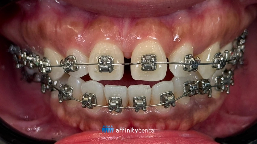 Close-up of teeth with newly installed self-ligating metal braces at Affinity Dental Clinics.