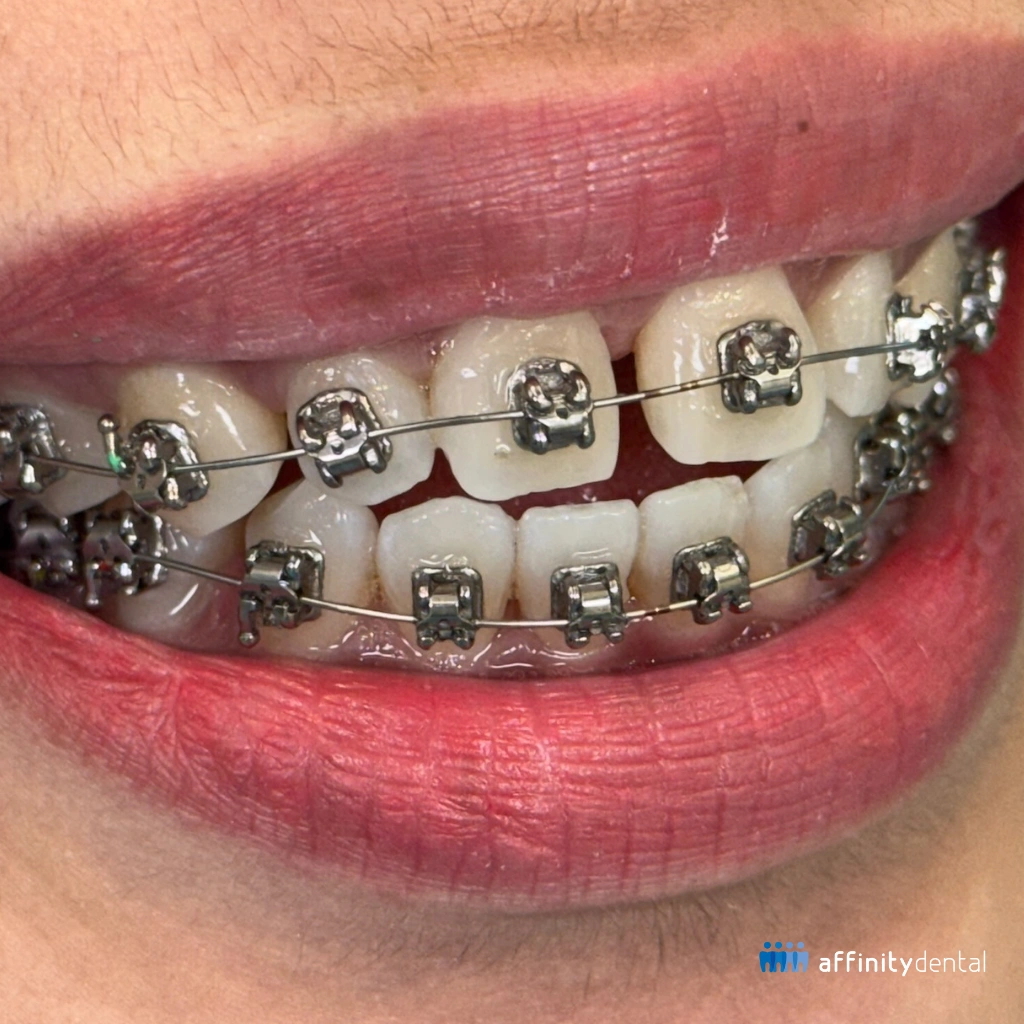 Close-up of patient wearing self-ligating braces at Affinity Dental Clinics