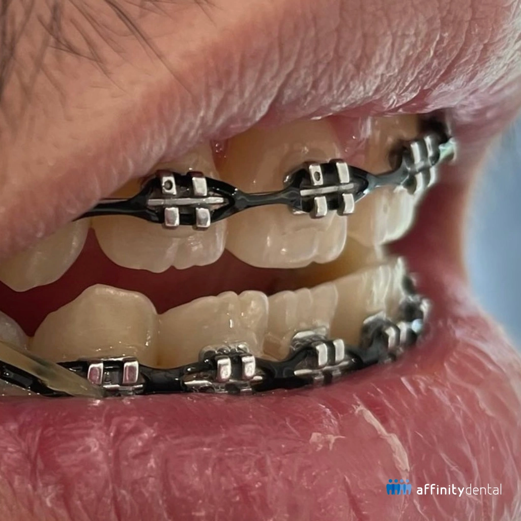 Close-up of patient wearing traditional metal braces with elastic ligatures at Affinity Dental Clinics