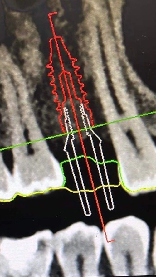 CBCT scan showing guided digital planning for precise dental implant placement at Affinity Dental Clinics.