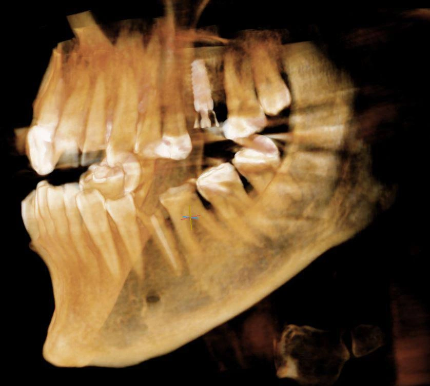 CBCT scan image of the lower and upper jaw showing teeth, roots, and dental implants for surgical planning