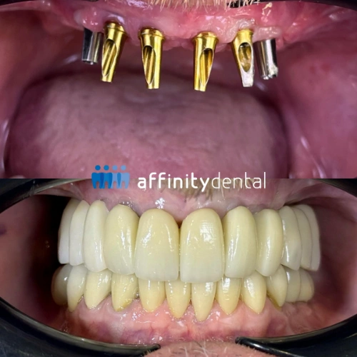 Before and after image of a full mouth dental implant restoration with zirconia fixed bridge at Affinity Dental Clinics in the Philippines