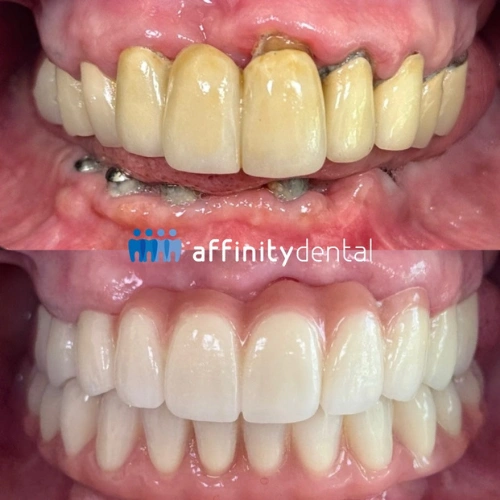 All-on-X dental implant with lower denture and zirconia bridge by Dr. Del Mundo for elderly female patient from New York at Affinity Dental Clinics Makati.