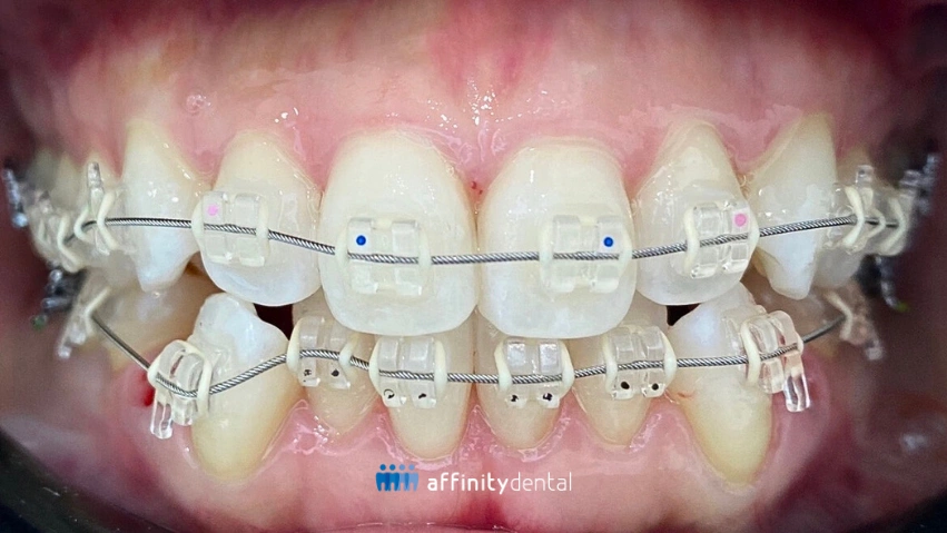 Close-up view of ceramic braces on upper and lower teeth, showing clear brackets with metal archwire.