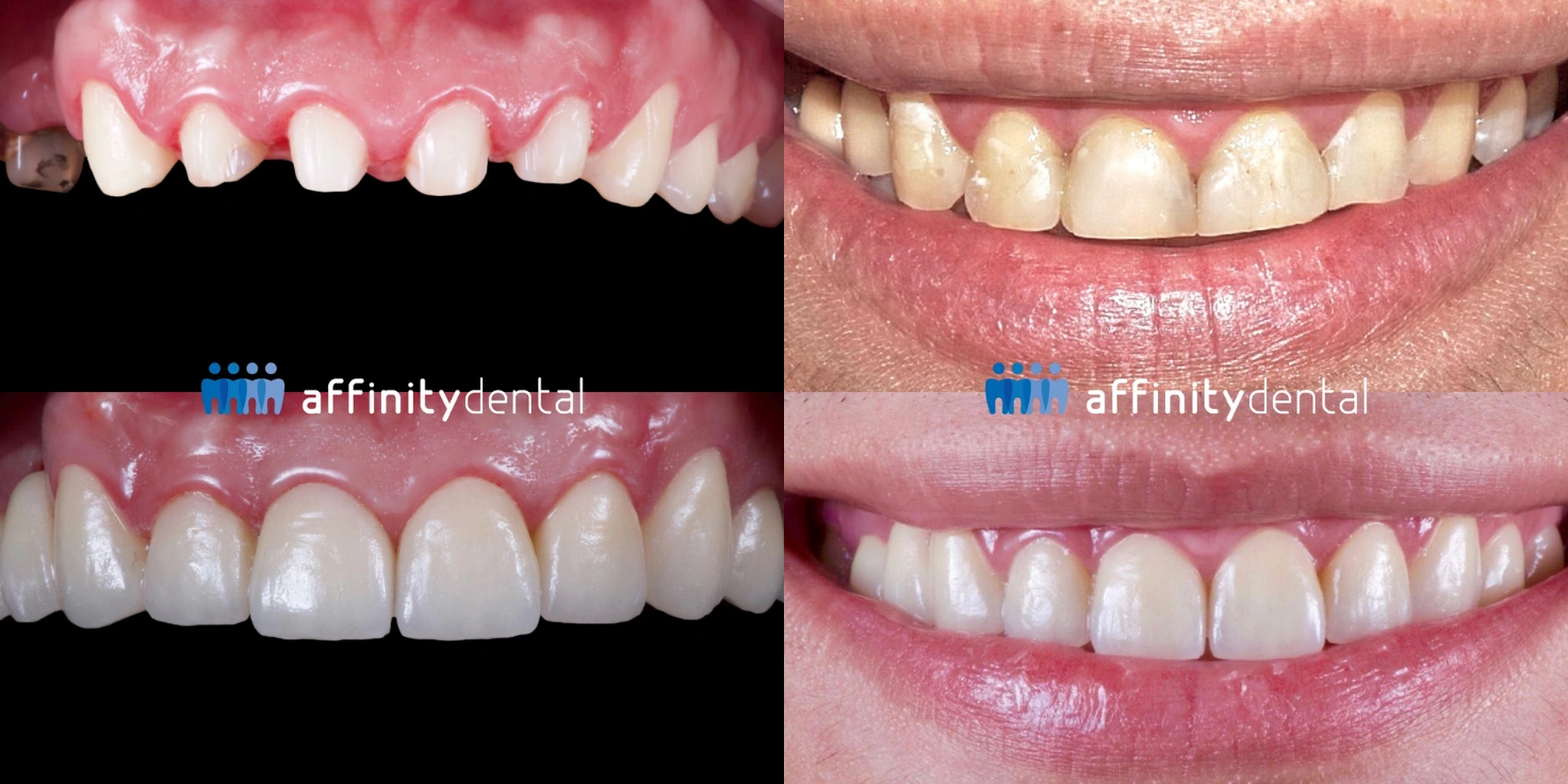 Before and after smile showing upper teeth restored with a combination of zirconia bridge, zirconia crowns, and porcelain veneers for a bruxism patient at Affinity Dental Clinics
