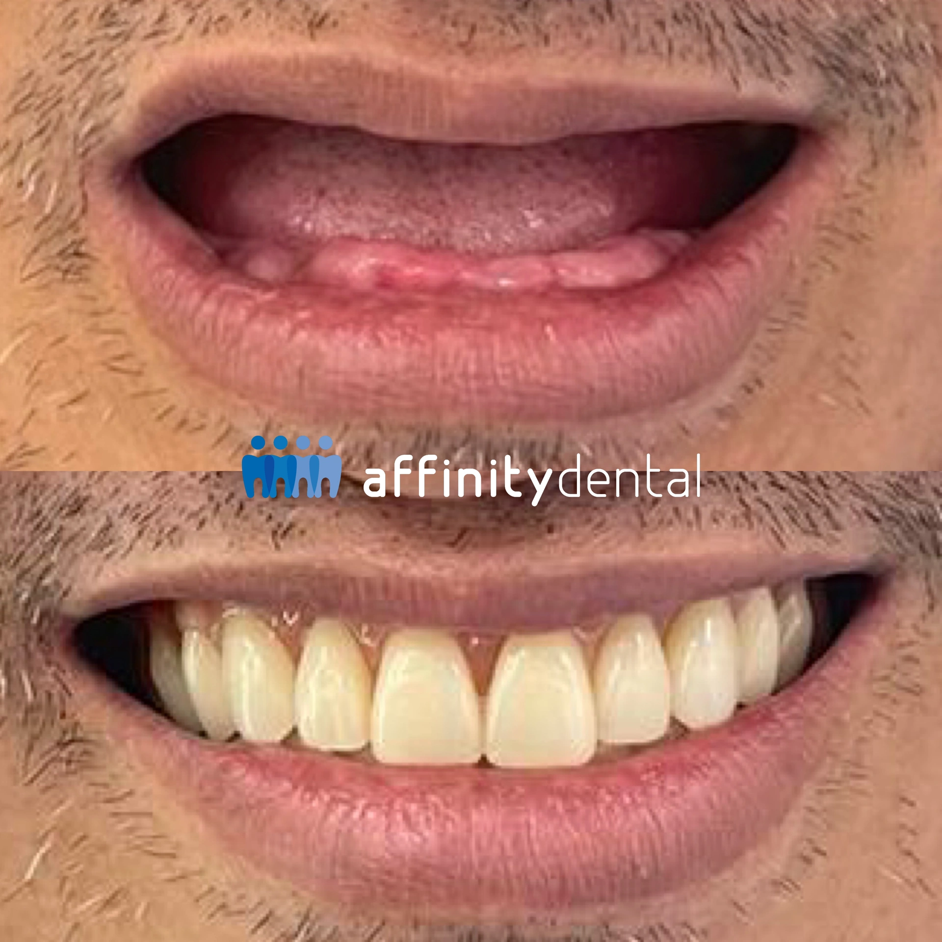 Before-and-after smile showing restoration with complete dentures at Affinity Dental Clinics BGC High Street