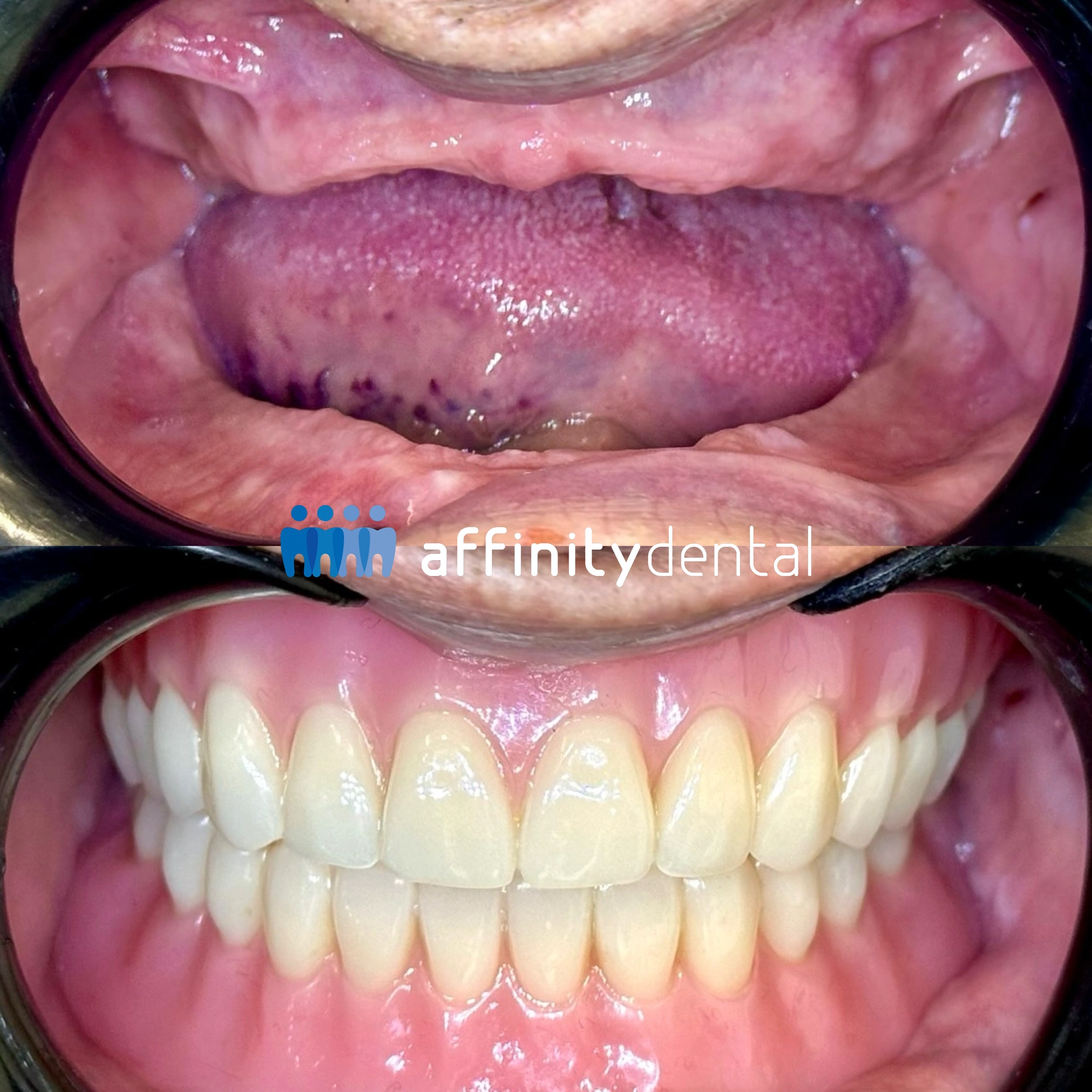 Before-and-after clinical photos showing restoration with complete dentures at Affinity Dental Clinics Alabang
