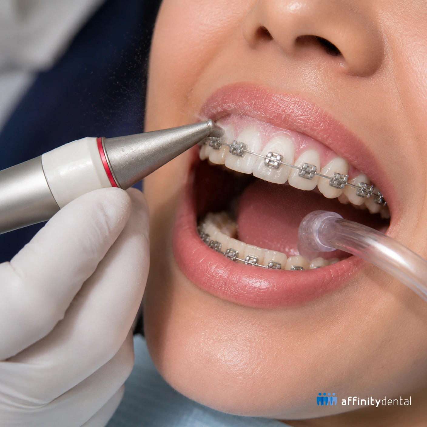 Close-up of a dentist performing AirFlow teeth cleaning on a patient with braces to remove plaque, biofilm, and surface stains around orthodontic brackets.