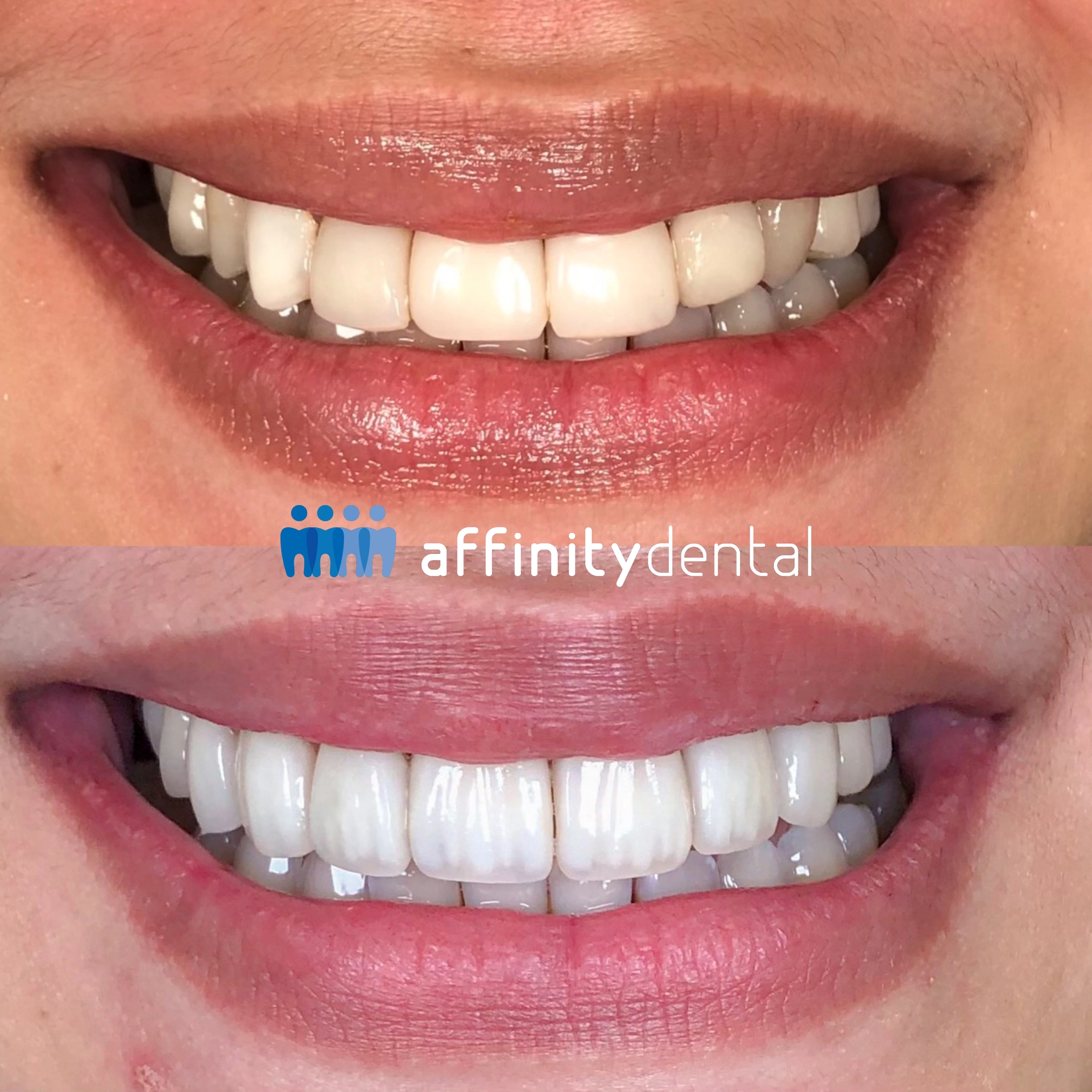 Before and after smile showing the results of Emax porcelain veneers treatment at Affinity Dental Clinics Ortigas.