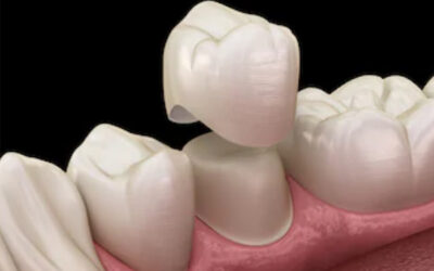 Do you need a crown after root canal treatment?