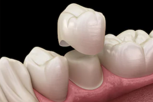 Do you need a crown after root canal treatment?