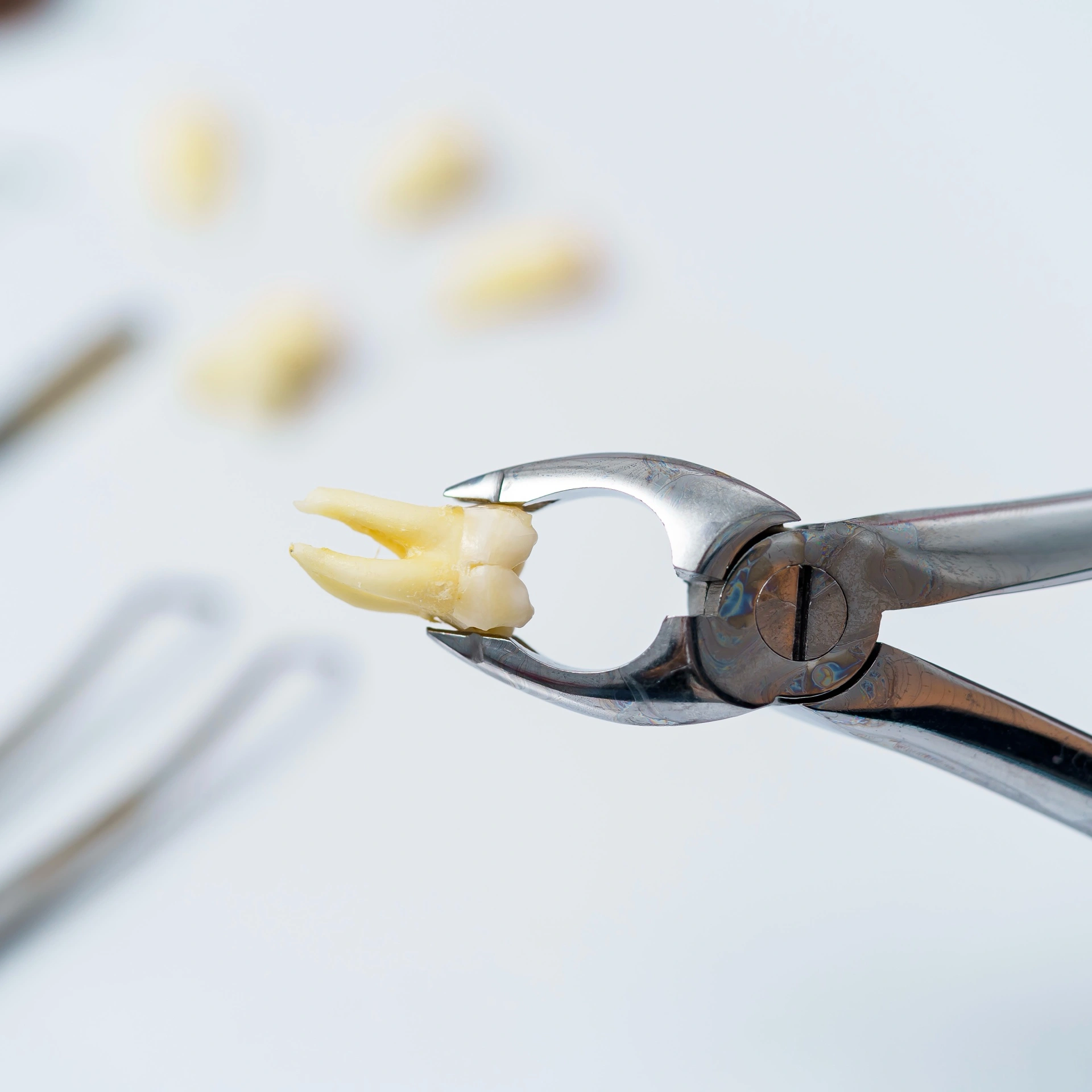Close-up of extracted molar tooth held by dental forceps after removal.