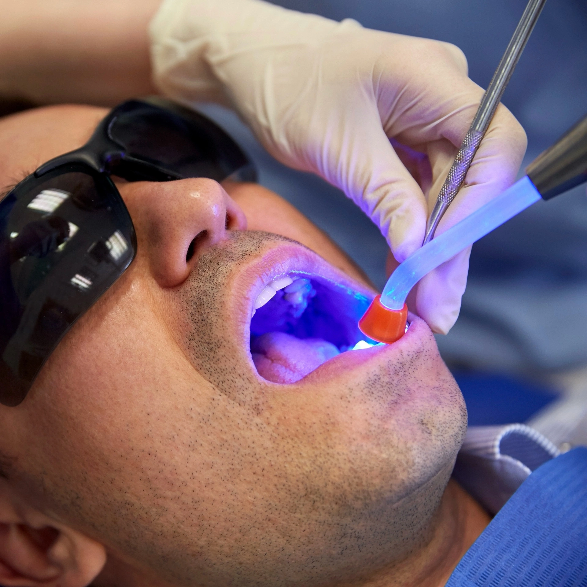 Male patient wearing protective glasses during a dental filling procedure with blue light-curing technology.