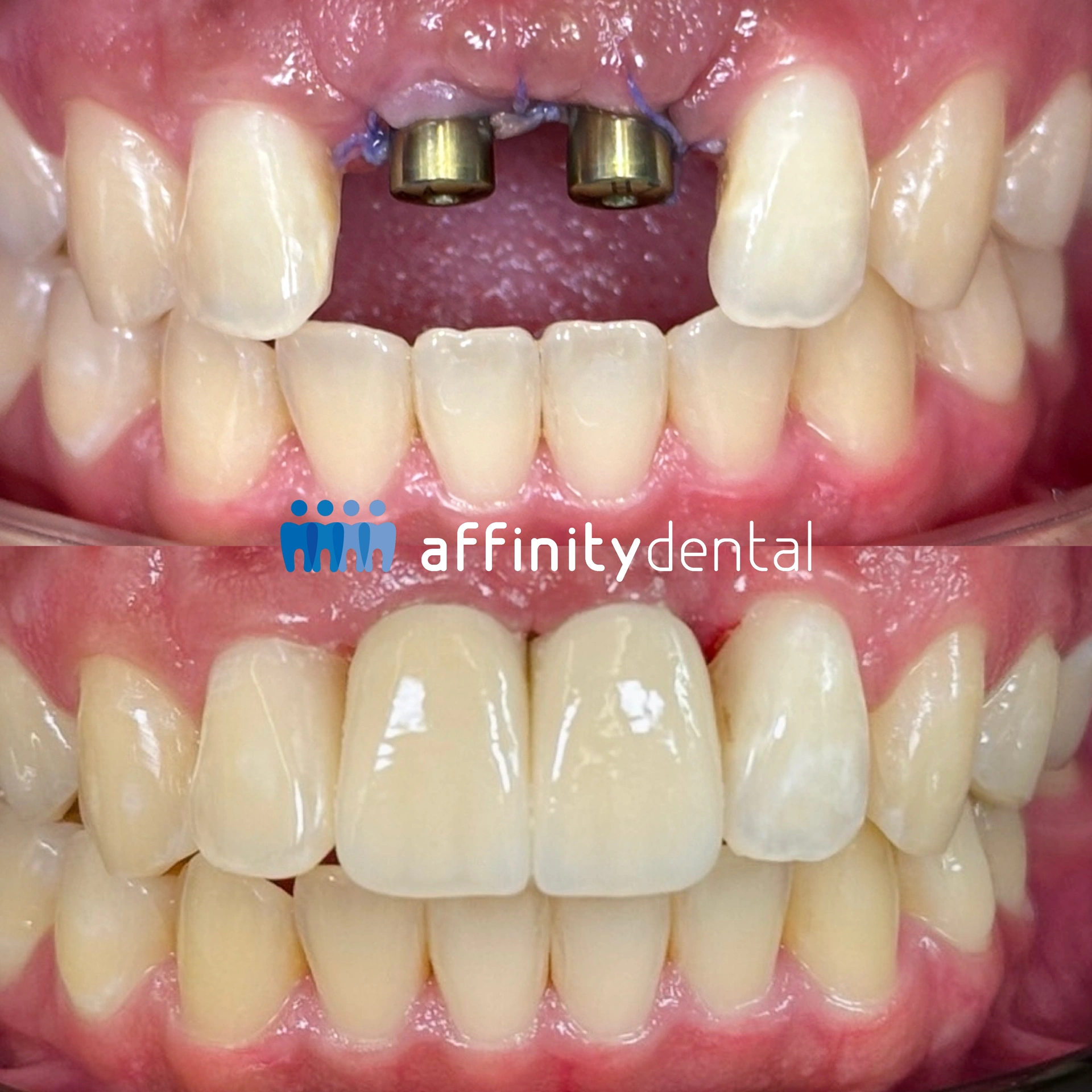 Before and after photo showing missing upper front teeth replaced with dental implants and crowns
