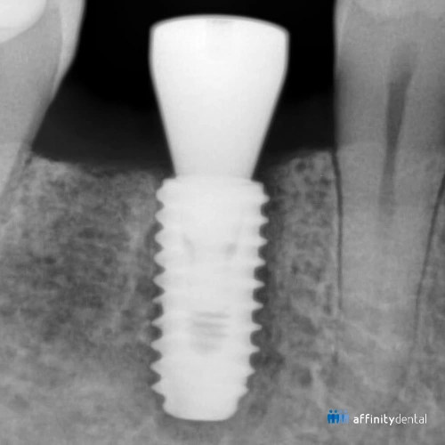 Dental X-ray showing a titanium implant with healing abutment in place and surrounding bone density indicating osseointegration
