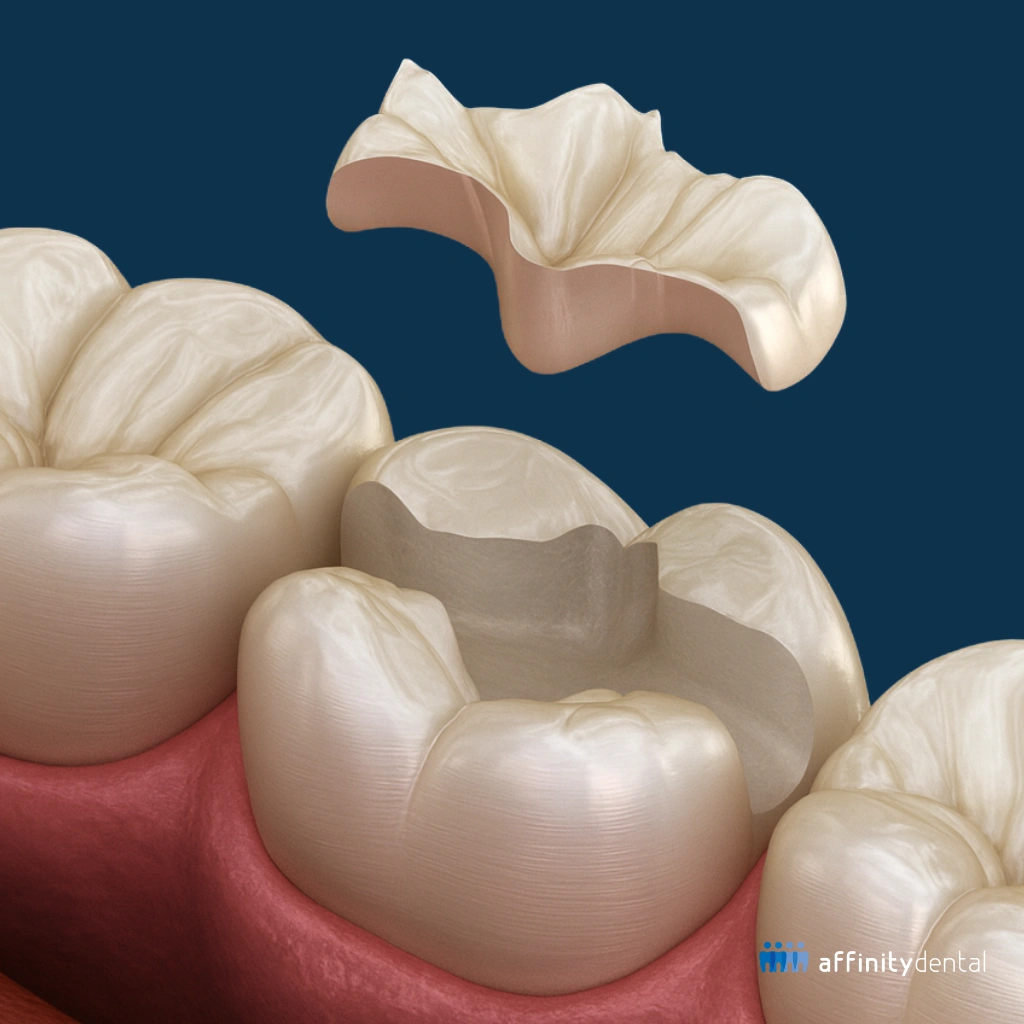 Hyper realistic 3D illustration of a zirconia dental inlay hovering above a prepared molar tooth before cementation