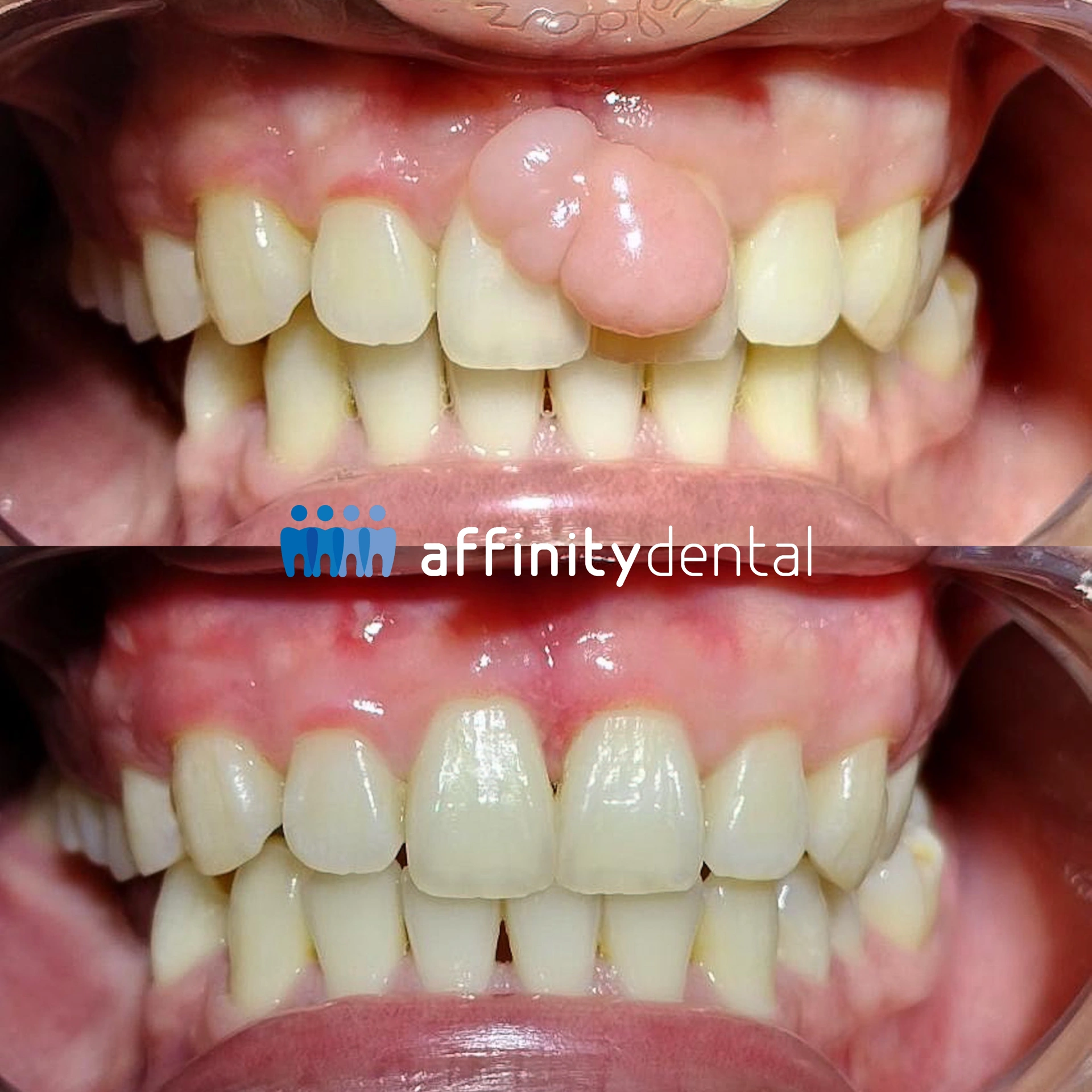 Before-and-after photos of a patient showing a large gingival fibroma removed through excision at Affinity Dental Clinics.