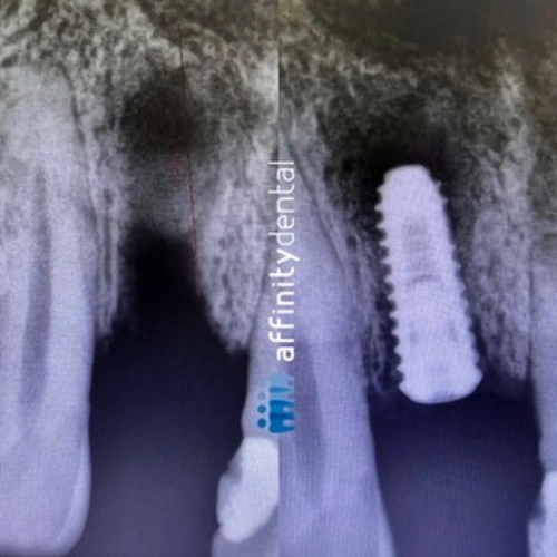 Dental X-ray showing extraction site and immediate placement of a single dental implant at Affinity Dental Clinics