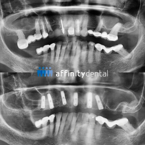 Panoramic X-ray showing multiple extractions and immediate dental implant placements at Affinity Dental Clinics