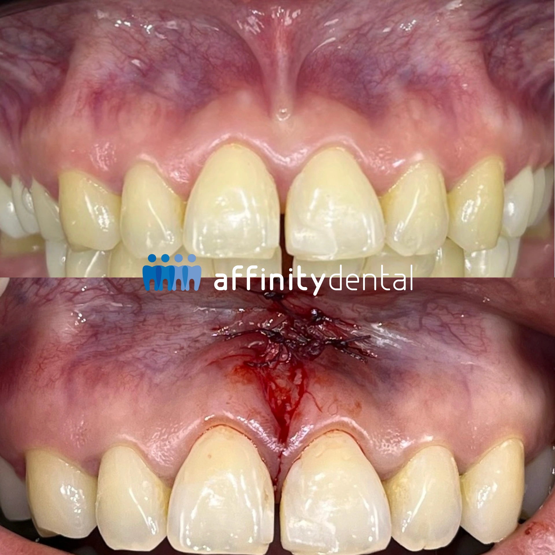 Close-up before-and-after photos of a patient’s upper front teeth showing a frenectomy procedure to address midline diastema prior to orthodontic treatment at Affinity Dental Clinics Makati.