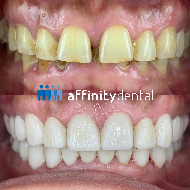 Before and after photo showing full mouth rehabilitation using full contour zirconia crowns in a patient with worn, stained teeth due to heavy bruxism.