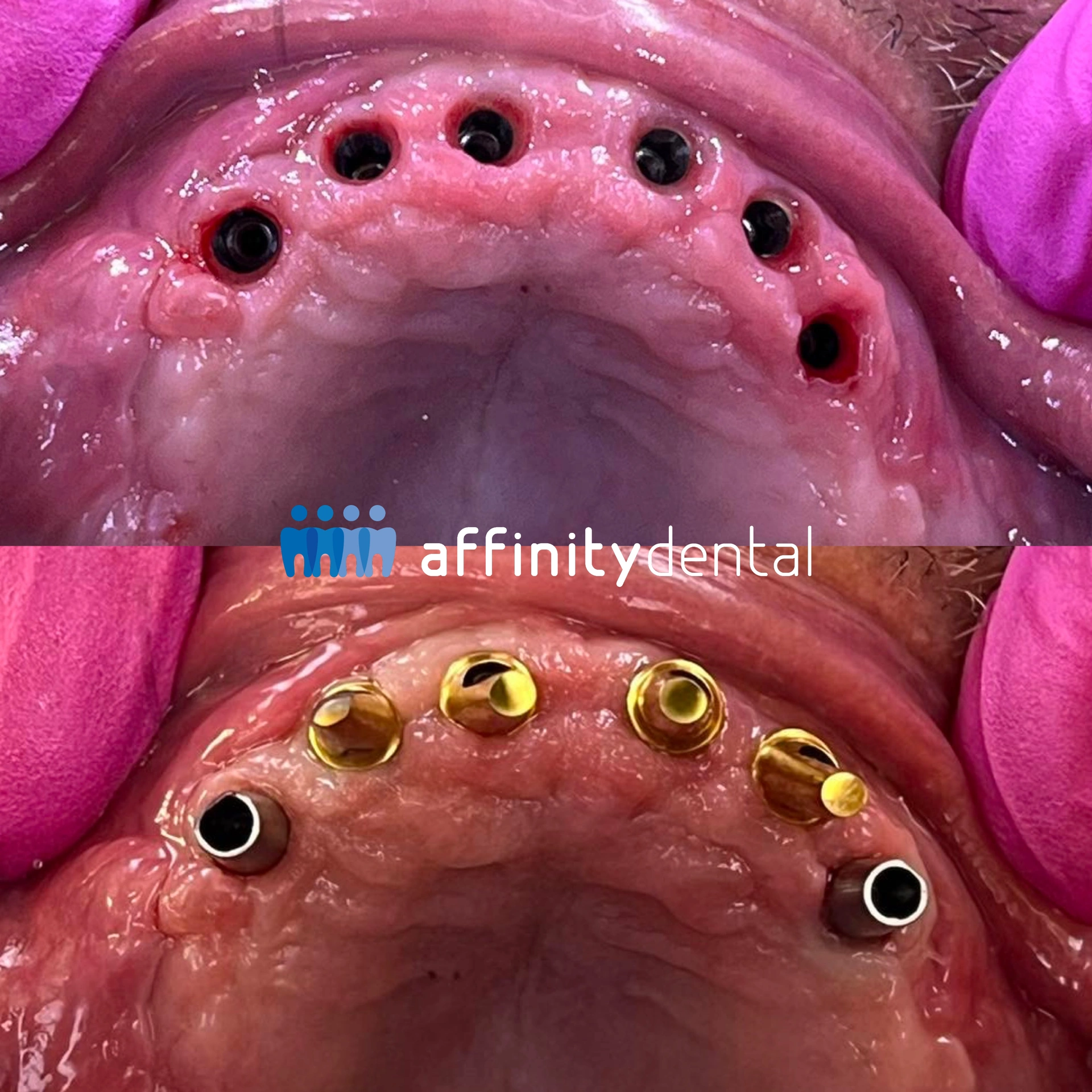 Close-up of a patient’s upper arch with multiple dental implants placed and fitted with healing abutments at Affinity Dental Clinics.