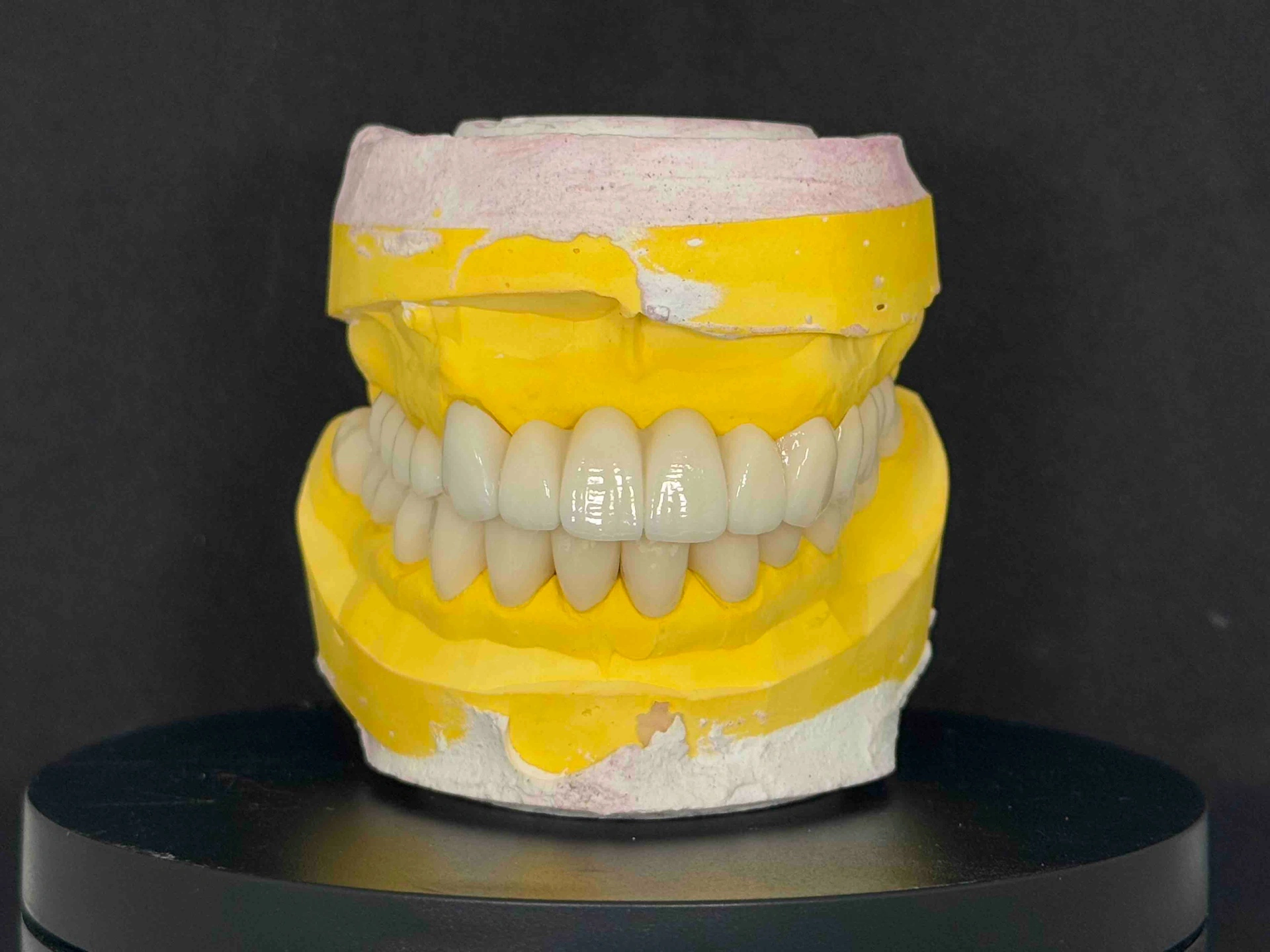 Model of full mouth zirconia crowns and bridges crafted at Affinity Dental Clinics’ in-house dental laboratory.