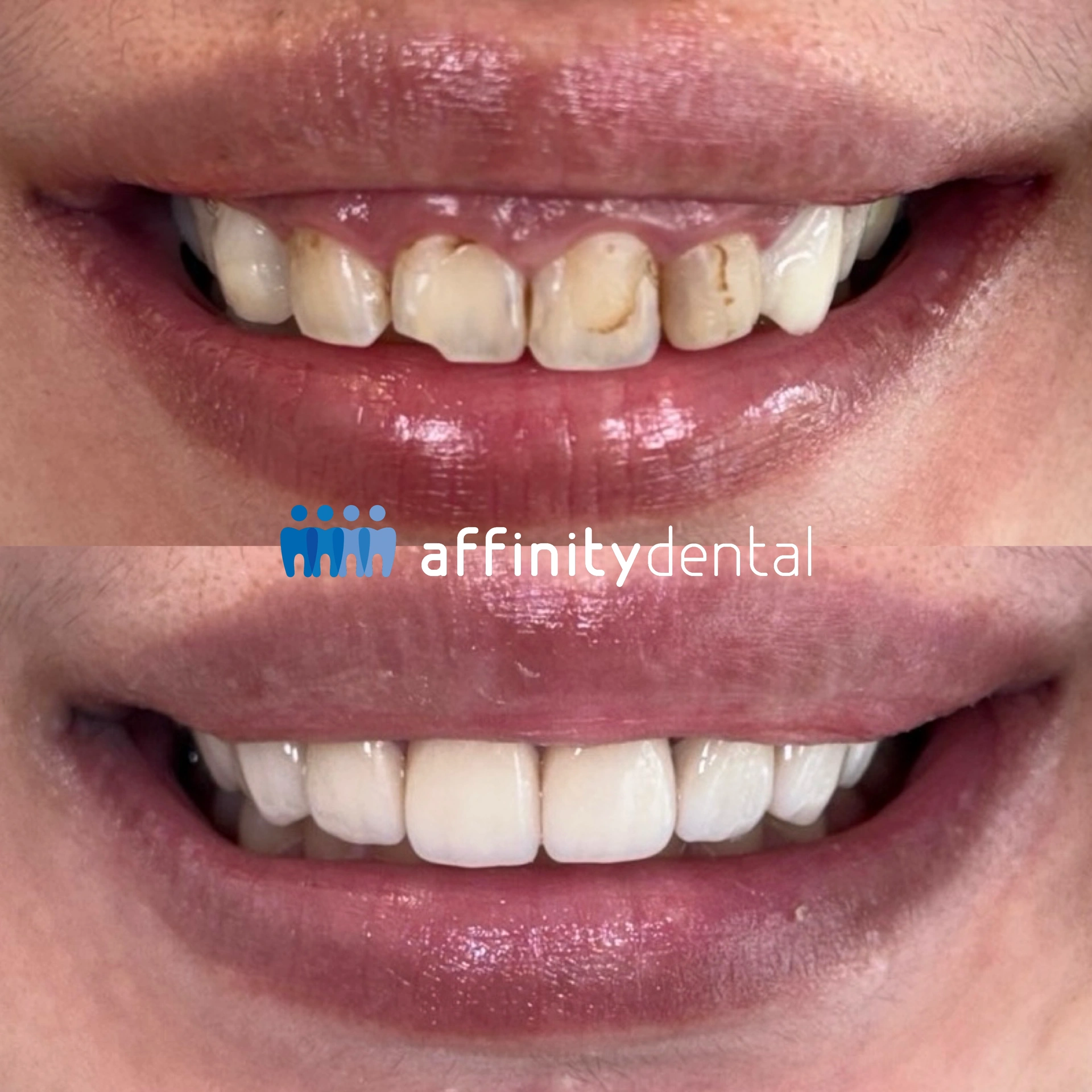 Before-and-after smile showing stained, uneven teeth corrected through gingivectomy and zirconia crowns at Affinity Dental Clinics Makati.