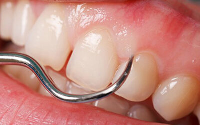 Gingivitis: Are your gums healthy?