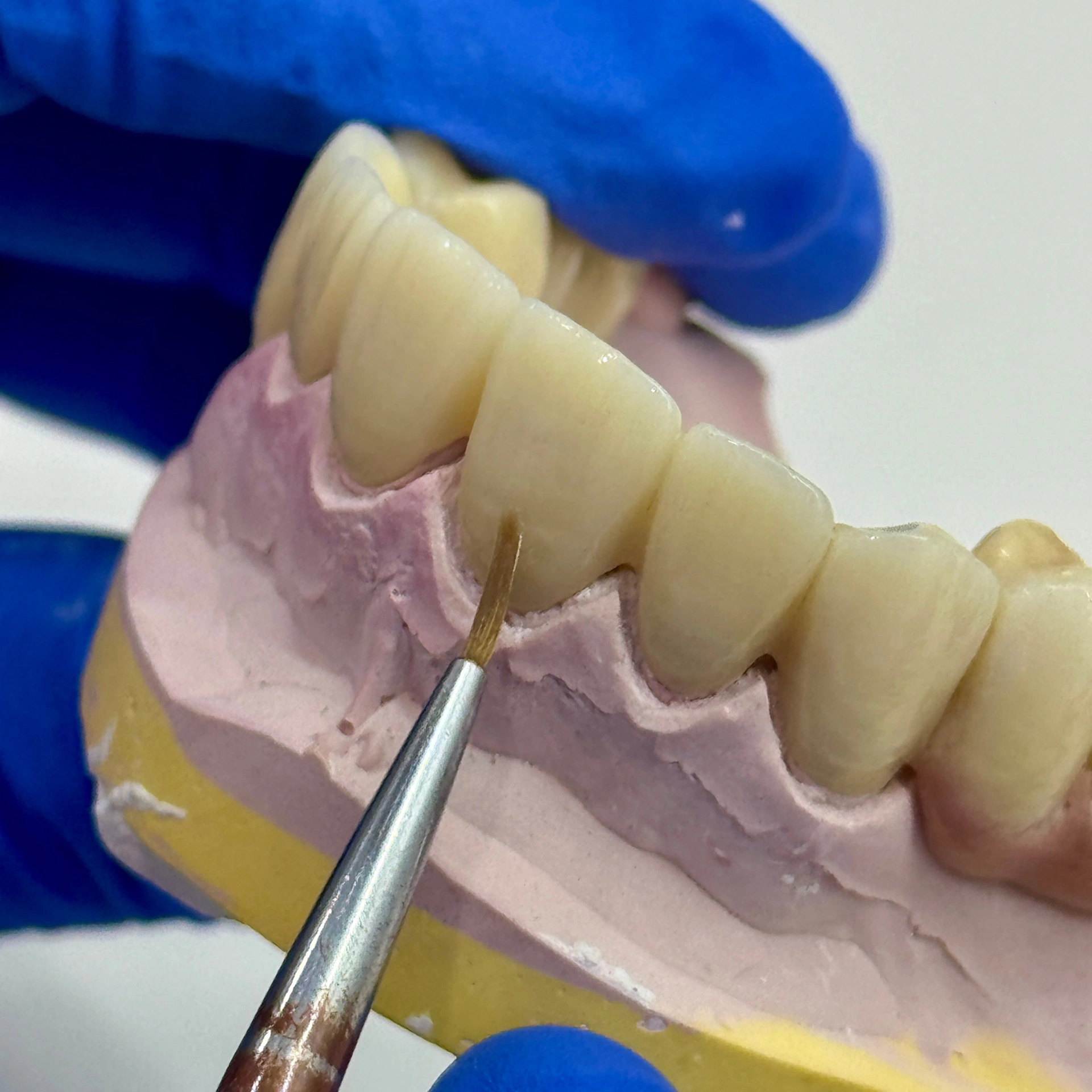 Dental technician applying glaze and stain to zirconia crowns, combining digital precision with human artistry at Affinity Dental Clinics.