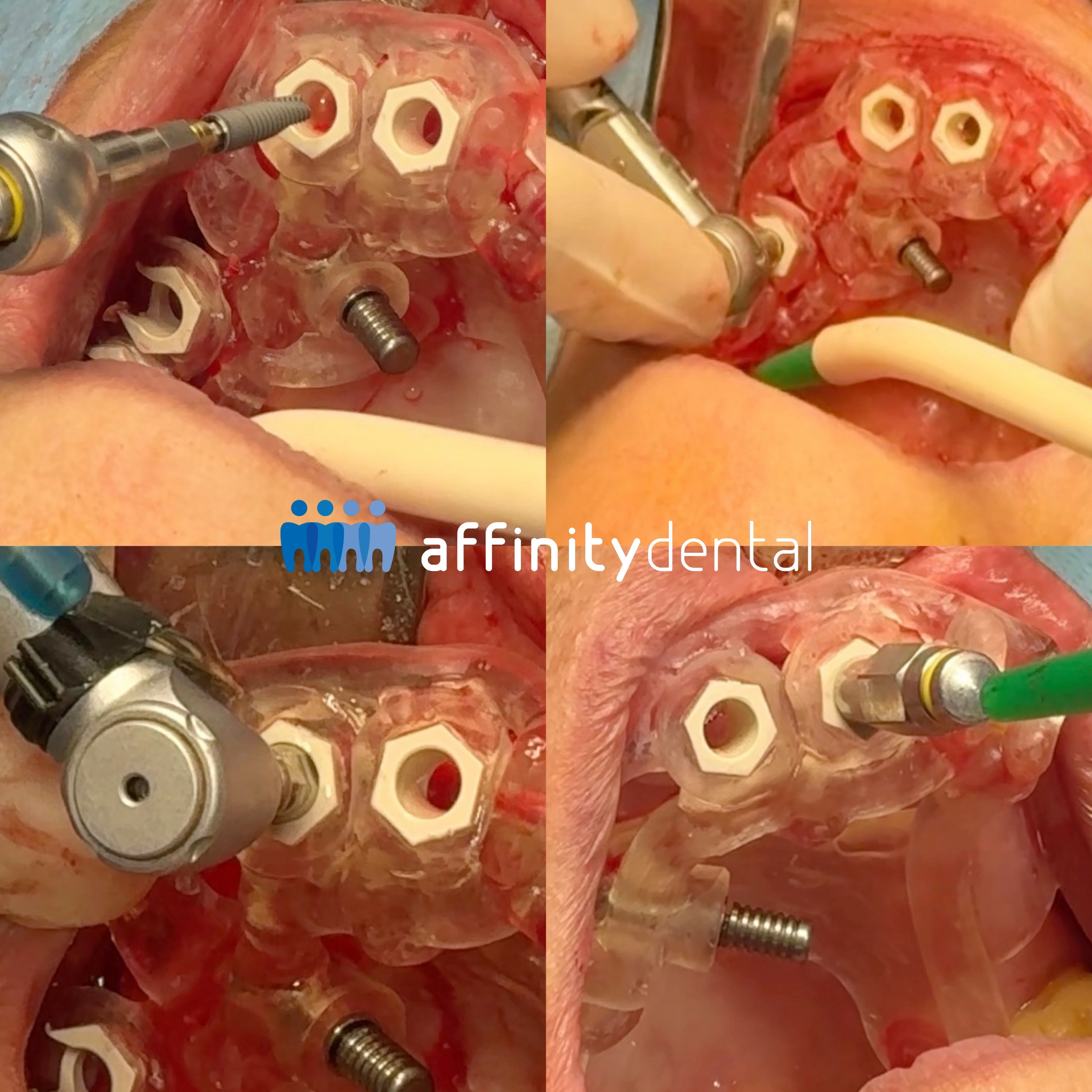 Clinical procedure showing guided dental implant placement using a 3D printed surgical guide with multiple sleeves at Affinity Dental Clinics Makati.
