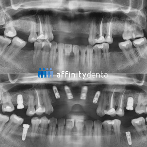 Before and after panoramic X-ray showing full mouth dental implants performed by Dr. Villanueva, Chief Implant Specialist at Affinity Dental Clinics Makati.
