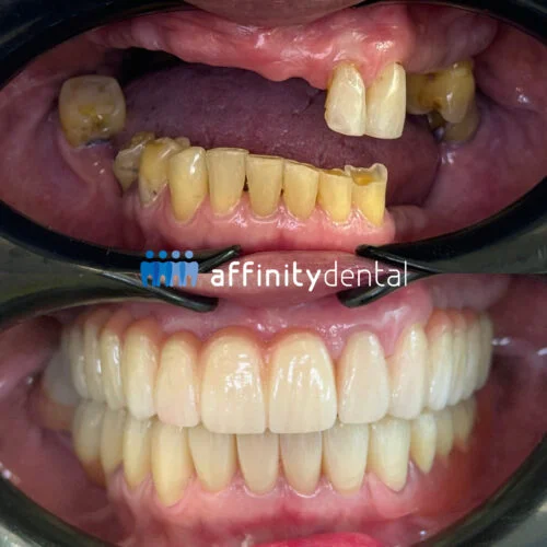 Before and after full mouth smile makeover with dental implant supported Zirconia fixed bridges and crowns, performed by Dr. Villanueva at Affinity Dental Clinics Makati.