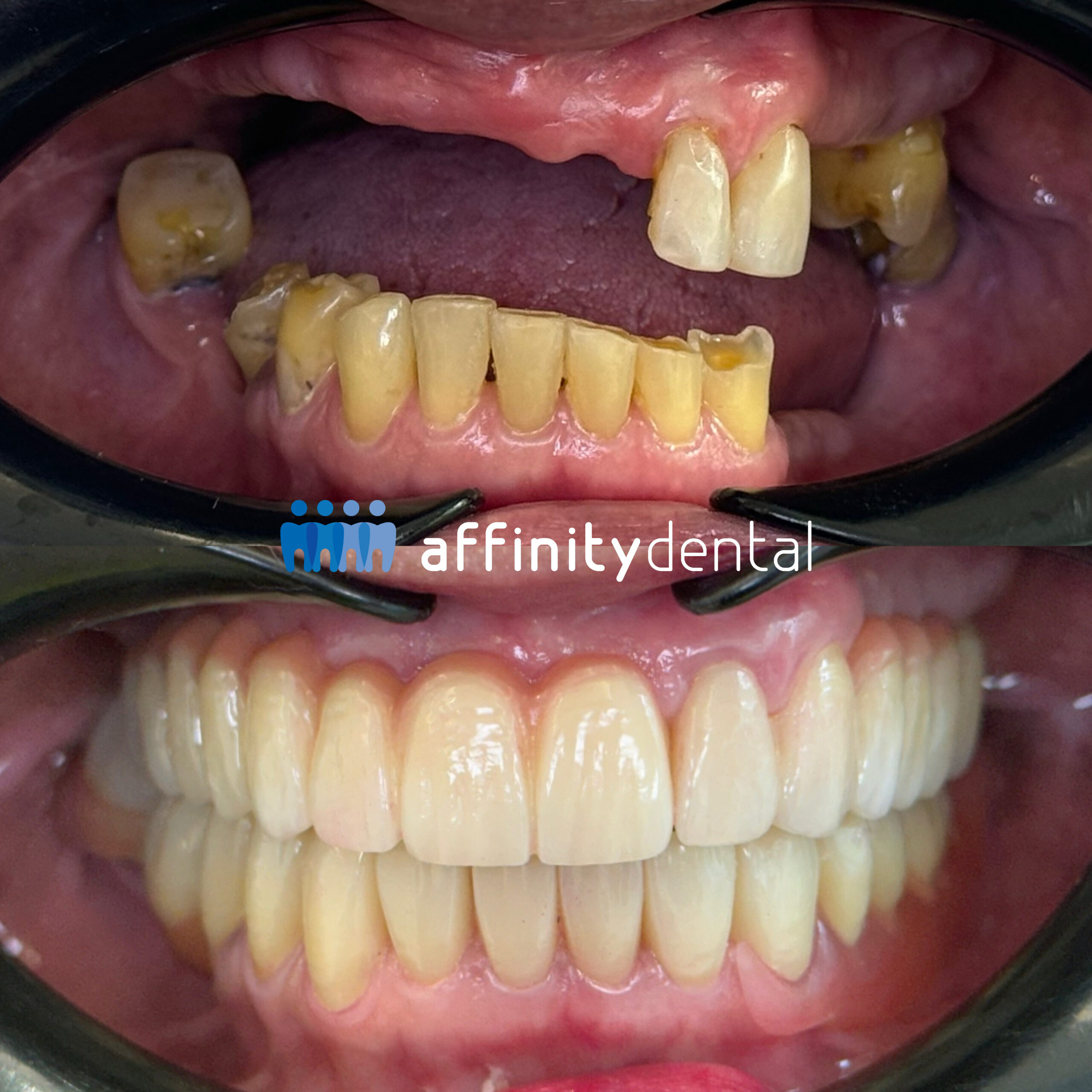 Before and after full mouth smile makeover with dental implant supported Zirconia fixed bridges and crowns, performed by Dr. Villanueva at Affinity Dental Clinics Makati.